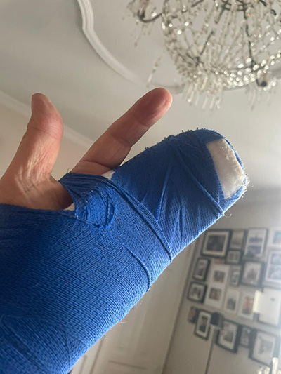 Zeit für kreative Ideen, verletzte Hand